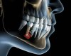 Gaziemir Ağız Ve Diş Sağlığı Polikliniği Dt.ÖZGEN ÇAKIR(gaziemir Diş implant uygulamaları )