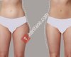 Liposuction - Liposakşın Yağ Aldırma Ankara