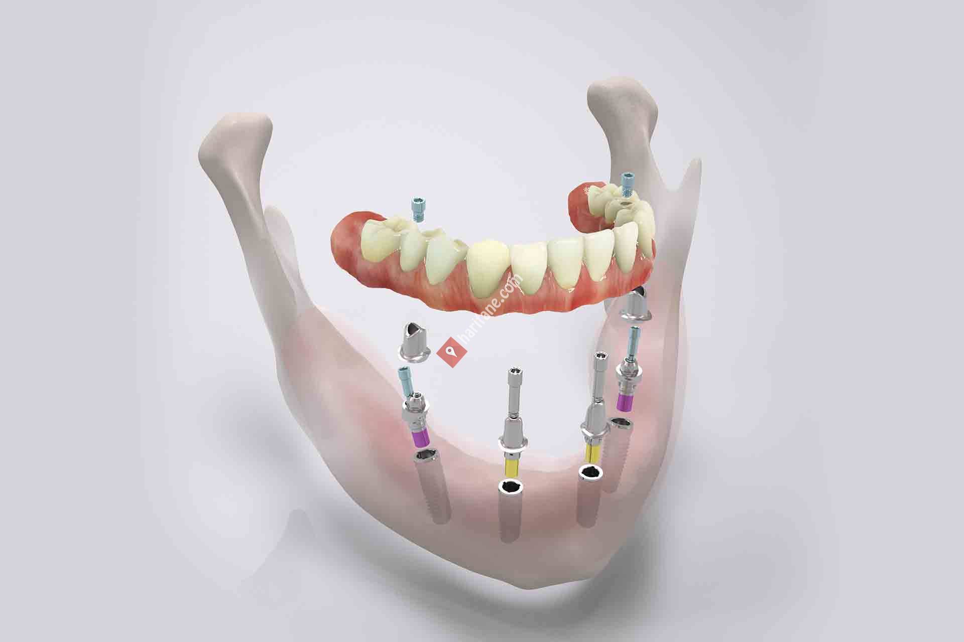 Несъемный зубной протез на 4 имплантах цена