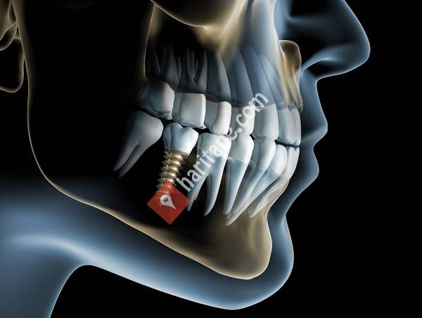 Gaziemir Ağız Ve Diş Sağlığı Polikliniği Dt.ÖZGEN ÇAKIR(gaziemir Diş implant uygulamaları )