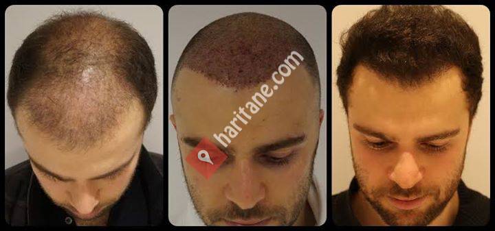 Hair Transplant Turkey-Europe